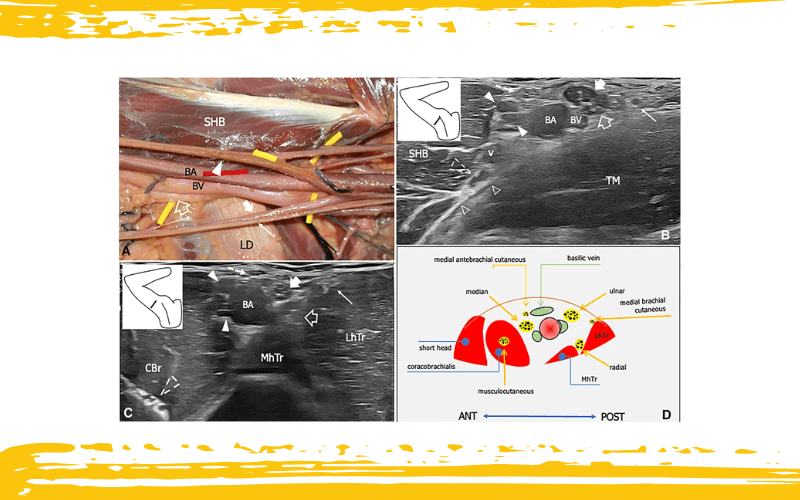 2. Nervio intercostobraquial y nervio cutaneo medial del brazo.png
